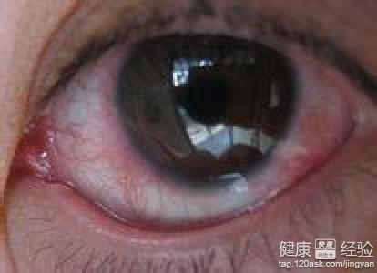 眼睛血絲紅眼病怎麼辦？