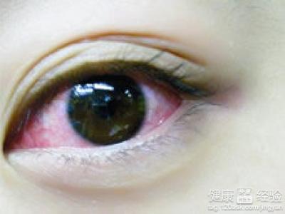 紅眼病會有什麼主要症狀