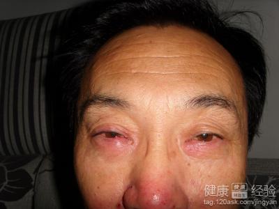 眼睛紅腫是什麼原因