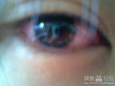 患上紅眼病會有怎樣的症狀？