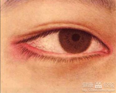 如何防治睑緣炎？