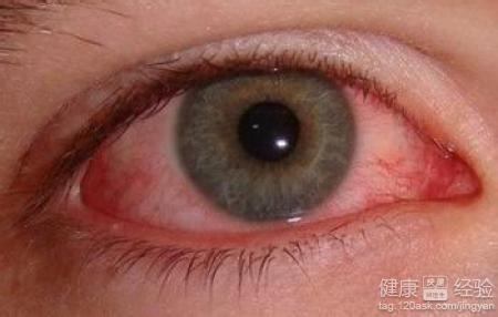 眼睛經常紅紅的是什麼原因的？