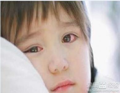 孩子患紅眼病怎麼辦