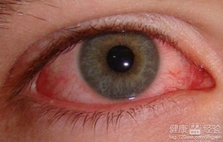 患有紅眼病應該注意什麼？