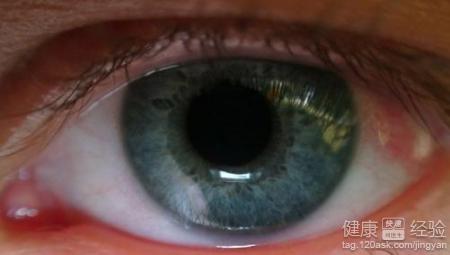 紅眼病應如何預防