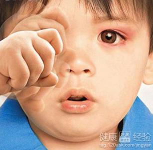 小孩子怎樣預防被傳染紅眼病