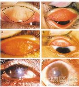 如何治療沙眼？中醫辨證治療沙眼