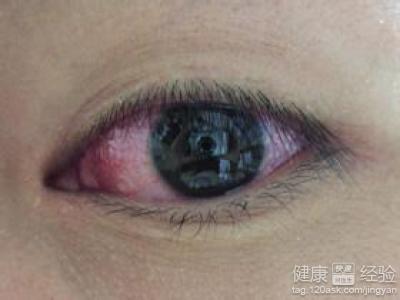 慢性結膜炎和沙眼不同