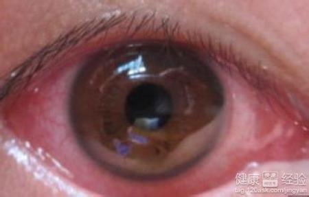 沙眼是怎麼引起的