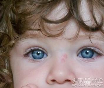 沙眼是由什麼引起的