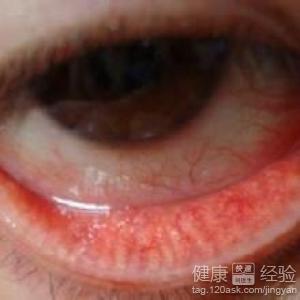 沙眼能不能治好