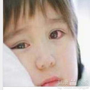沙眼日常護理有哪些注意事項