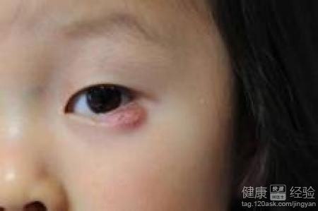 小孩能接受的麥粒腫治療法是什麼