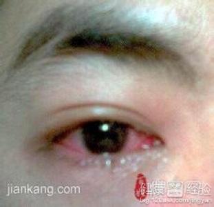 沙眼有哪些症狀