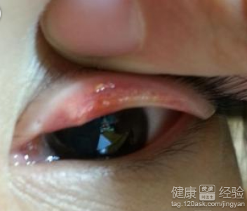 沙眼衣原體感染用什麼口服用藥