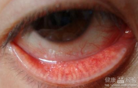 患沙眼會使眼睛失明嗎