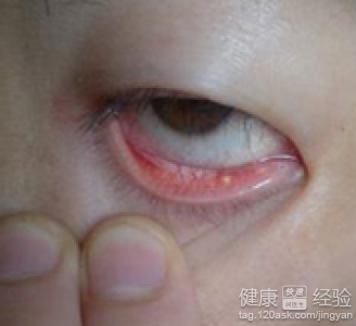 沙眼的並發症主要有哪些