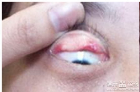 哪些方法可以有效預防沙眼