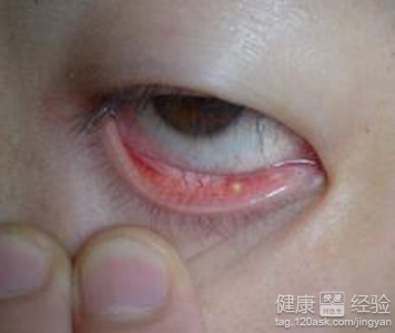 沙眼是一種什麼疾病