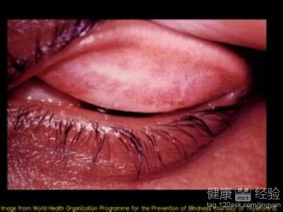 婦女感染沙眼衣原體怎麼辦