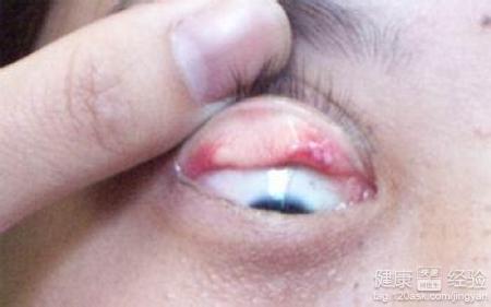 沙眼和灰指甲影響生育嗎，應該怎麼治療