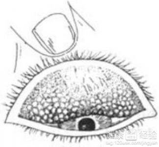 結膜炎沙眼綠泡怎麼治療