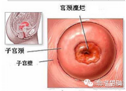 宮頸糜爛帶沙眼支原體應該怎麼治療好