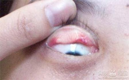 沙眼結膜炎怎麼治療