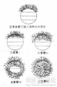 得了沙眼怎麼治療防御