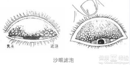 兒童沙眼有什麼症狀