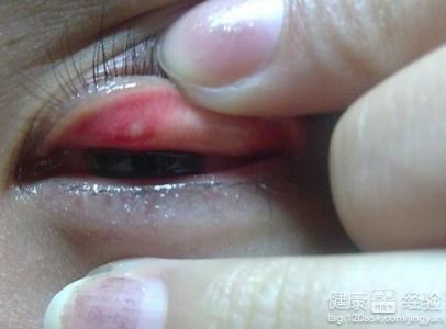 眼部有結石是沙眼嗎