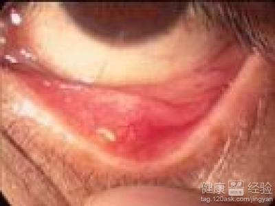 得了沙眼了要怎麼辦？