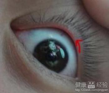 引起沙眼的一些原因有哪些
