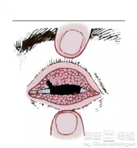 治療沙眼需要注意的事項