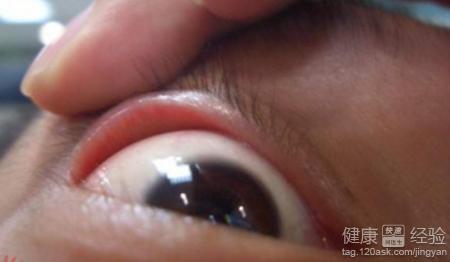 沙眼該怎麼去治療