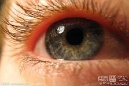 怎麼預防沙眼
