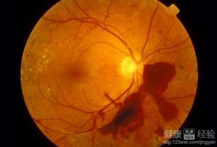 愛熬夜的男人小心眼睛視網膜病日常防護
