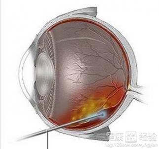 視網膜脫落的症狀
