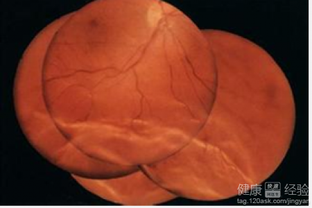 右眼孔源性視網膜脫有什麼危害