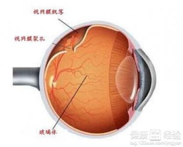 視網膜脫落移植手術大概需要多少錢