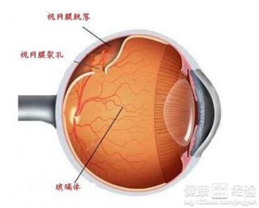 先天右眼異常使視網膜脫落如何治