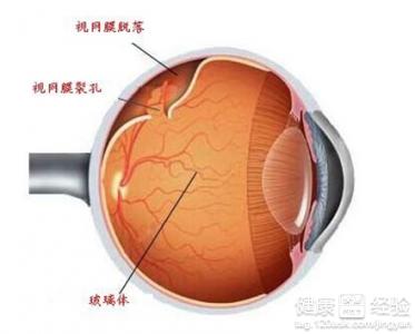 先天右眼異常使視網膜脫落如何治