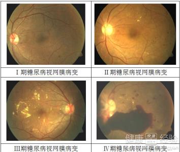 糖尿病性視網膜病變怎樣治療