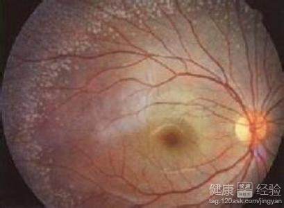 眼底水腫視網膜病變是怎麼回事
