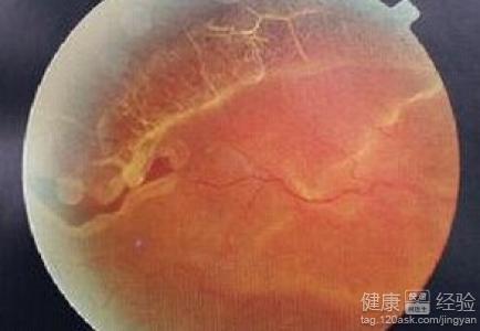 先天性視網膜脫落怎樣治療