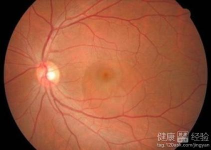 雙眼中心性漿液性脈絡膜視網膜病變原因有哪些