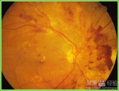 放射性視網膜病變、眼底出血吃什麼藥