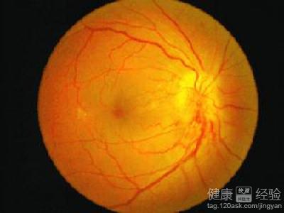 中心性射出性視網膜病變多發於哪些人群