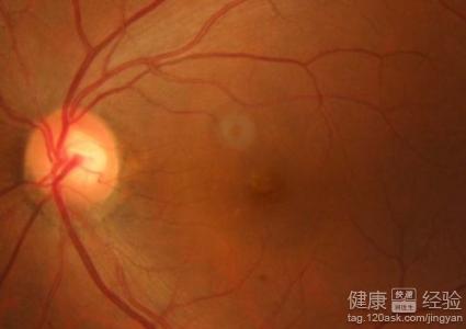 黃斑性視網膜病變要做熒光照影嗎