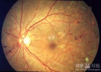 糖尿病晚期患者視網膜易發生病變嗎